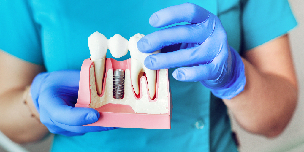 Qual a vida útil de um implante dentário?