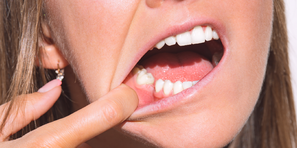Quais as consequências da ausência de dentes?