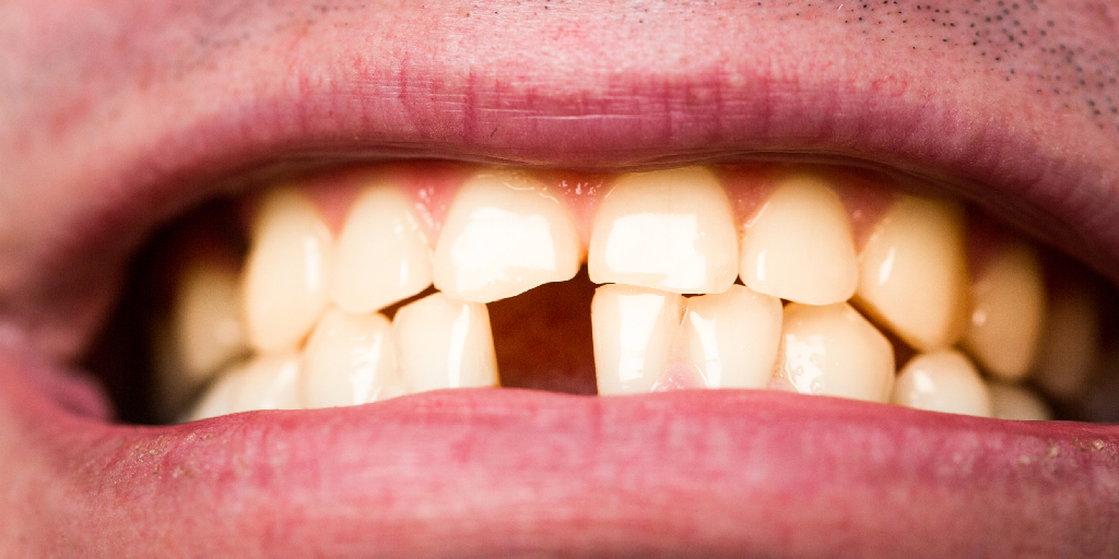 Descubra as principais doenças que causam perda de dentes