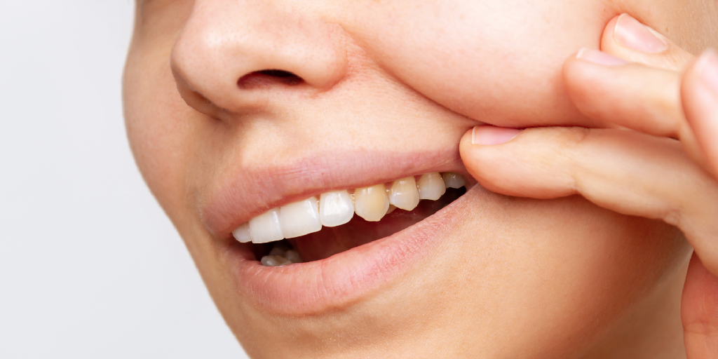 Sofre com Manchas nos dentes? Entenda os causadores e como remover