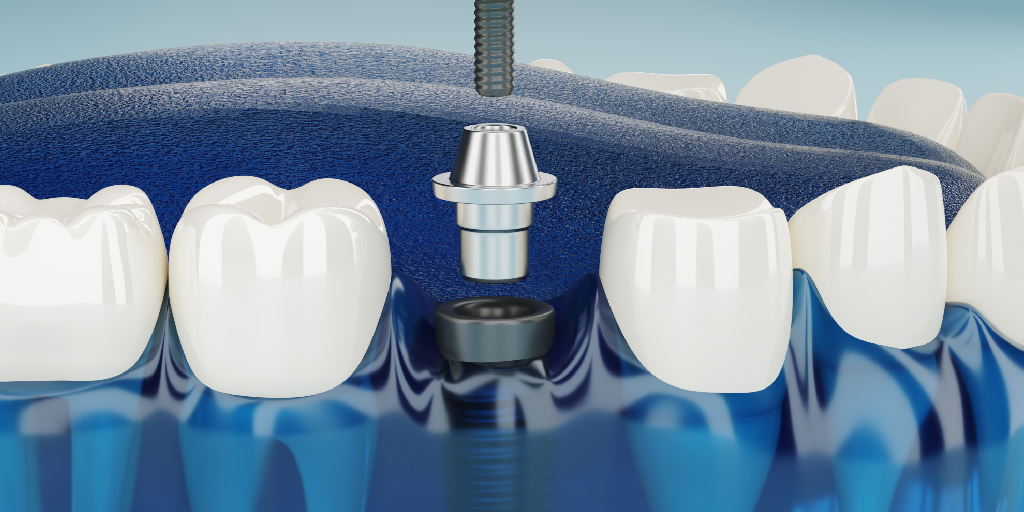 Conheça os principais tipos de implantes dentários existentes