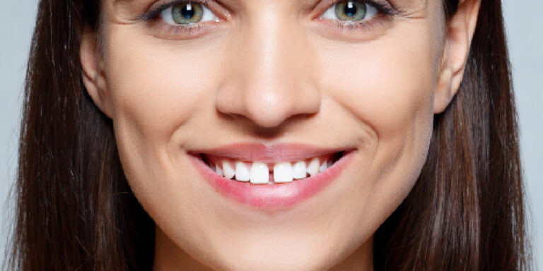 Dentes anteriores separados: como resolver esse problema?