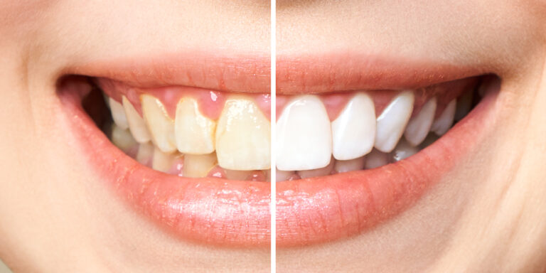 Conheça os Tipos de Clareamento Dentário em Santo Amaro – SP