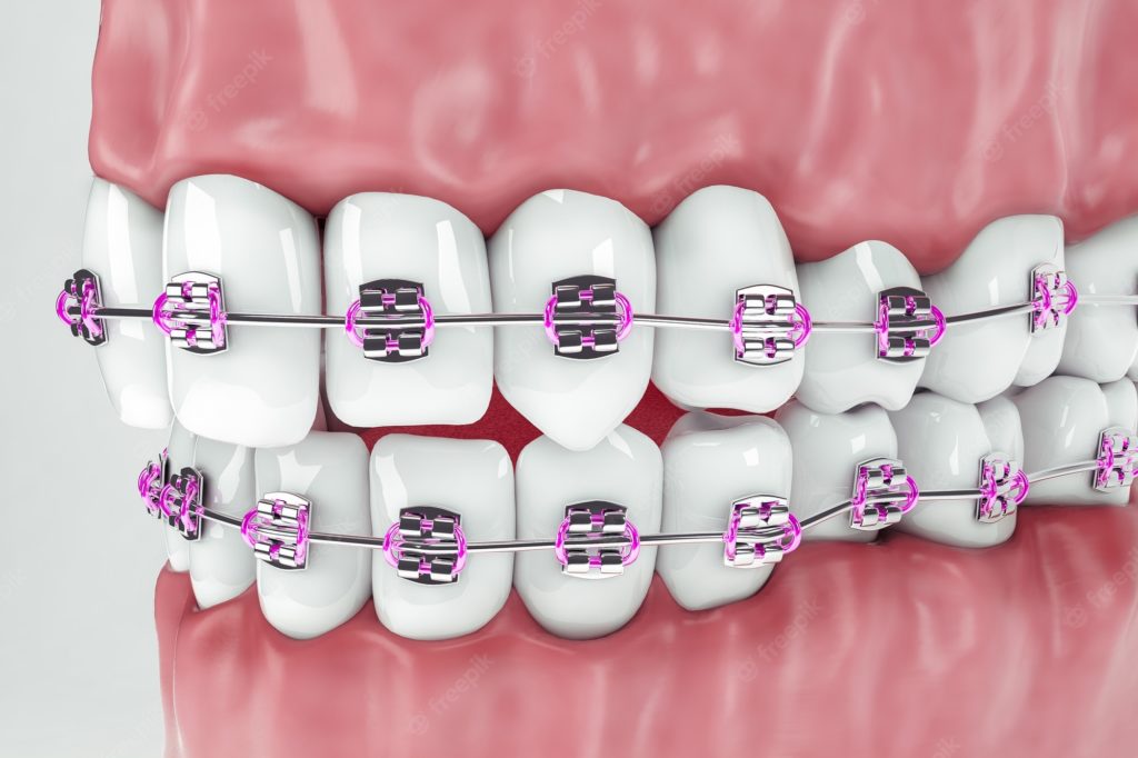 Materiale Dentale Azdent Fasce Legatura Preformate Per Apparecchio Ortodontico - Filo Ortodontico AZDENT Fasce Legatura Ortodontica Materiale Dentale Azdent Fasce Legatura Preformate Per Apparecchio Ortodontico - Filo Ortodontico AZDENT Fasce Legatura Ortodontica